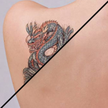 Eliminación de tatuajes, micropigmentación y microblading